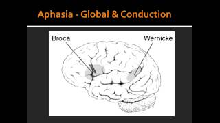 Aphasia  Global amp Conduction [upl. by Nyret]