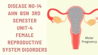 Hydatidiform MoleMolar pregnencyDisease14AHNBSN 3rdsemester Unit4female reproductive disorders [upl. by Maxantia]