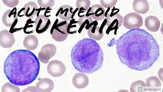 Chronic Lymphocytic Leukemia CLL Peripheral Blood Smear Hemepath Hematology Pathology [upl. by Liggitt799]