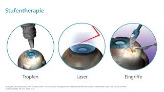 Endlich keine Augentropfen mehr Aktuelles von den VorderkammerImplantaten bei Glaukom [upl. by Nosydam]