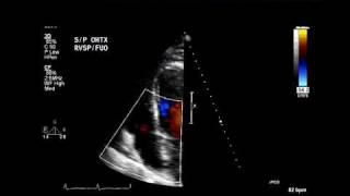 Eccentric tricuspid regurgitation jet suggests flail leaflet [upl. by Annaeg587]