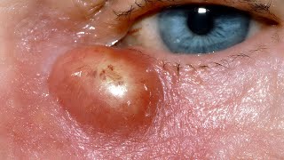 Lacrimal Abscess [upl. by Nea]