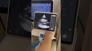 Portable Handheld Wireless Cardiac Ultrasound portableultrasound [upl. by Nollek]