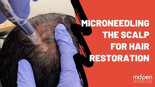 Microneedling The Scalp For Hair Restoration  MDPen [upl. by Paulette]