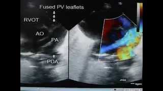 Pulmonar Atresia [upl. by Barolet]