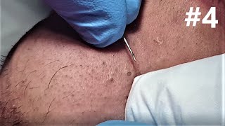 BIG BLACKHEADS EXTRACTIONS on Happy  4 [upl. by Nnednarb]