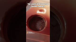 Layers of CSection Delivery ✨FASCINATING✨ shorts [upl. by Sices]