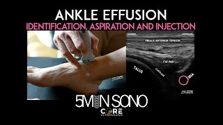 Ankle Effusion  Identification Aspiration and Injection [upl. by Avin]