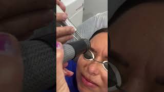 Laser Tattoo Removal Eyebrows [upl. by Martita]