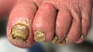 MUST WATCH THICK Nail Cutting On Patient With Out Of Body Experience 😨 [upl. by Aurelio]