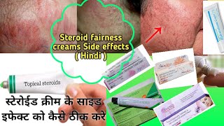 Harmful steroid  fairness cream  how to reduce side effects why you should avoid steroid creams [upl. by Vano]