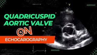 Quadricuspid aortic valve QAV  Aortic Valve with Four Leaflets  Left Ventricular Hypertrophy [upl. by Nomar781]