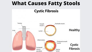 What Causes Fatty Stools [upl. by Eical]