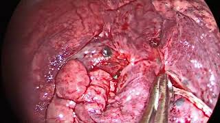 Uniportal VATS RML lobectomy [upl. by Edric]