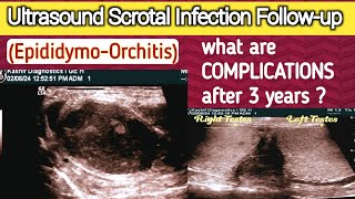 Chronic Scrotal Infection  Complications  Male Infertility  Epididymo Orchitis [upl. by Rinna]