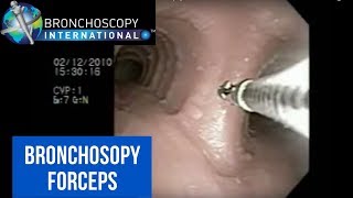 Flexible Bronchoscopy Basic Techniques for Forceps Biopsy [upl. by Baten]