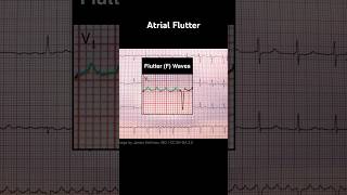 Atrial Flutter ECG Flutter F waves [upl. by Onitsuj]