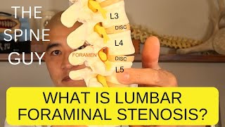 What is Lumbar Foraminal Stenosis [upl. by Fatsug]