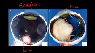 High Yield Topic Retinoblastoma  A Complete Review [upl. by Marja]