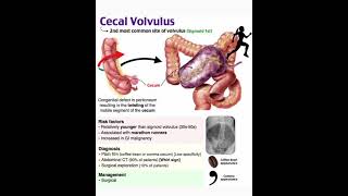 Cecal volvulus [upl. by Tri]