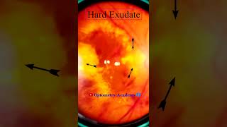 Diabetic retinopathy  Hemorrhages  Hard exudates  Fundus  Short Video 189 [upl. by Esertap]