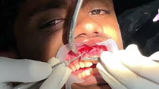 Maxillary tooth apicectomy  curettage and retrograde obturation [upl. by Inoj]