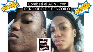 Combatí el ACNÉ con PEROXIDO DE BENZOILO [upl. by Aitekram]