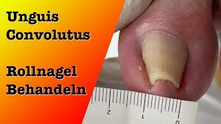 Unguis Convolututs Rollnagel Behandlung 1  podologinandrea [upl. by Maggs663]