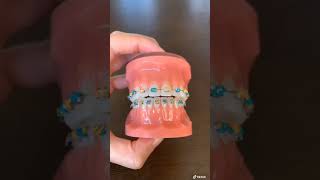 How to Wear Your Orthodontic Elastics  Dr Bar The Braces Doc [upl. by Ahsieyt]