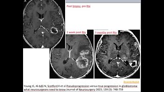 65 Pseudoprogression and pseudoresponse post treatment glioma MRI RANO Stupp Bevacizumab rCBV [upl. by Felt84]