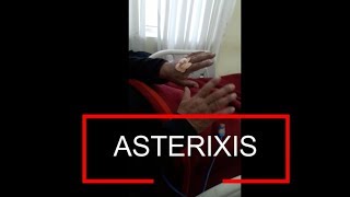 Asterixis  Flapping Tremor  Liver Flap [upl. by Irisa]