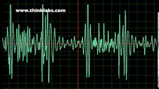 Atrial Septal Defect slow [upl. by Anwahsit159]