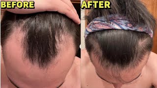 HYPERRESPONDER ON BIG 3  MICRONEEDLING HAIR LOSS STACK INSANE 5 MONTH RESULTS [upl. by Hailat]