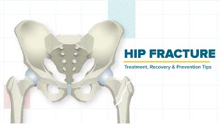 Hip Fracture  Treatment Recovery amp Prevention Tips [upl. by Enitsirhc751]