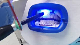 Teeth Whitening Methods and Gimmicks Dont waste your money [upl. by Jone]