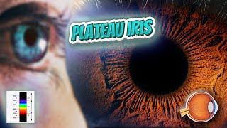 Plateau iris  Your EYEBALLS  EYNTK 👁️👁️💉😳💊🔊💯✅ [upl. by Eladal569]