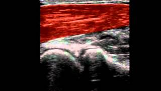 Musculoskeletal Ultrasound Elbow 1 anterior humeroradial longitudinal scan [upl. by Tippets240]