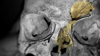 Frontal sinus communicating Nasal Cavity  Frontonasal Duct [upl. by Nylessej]