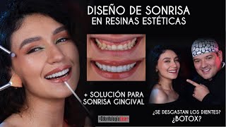 Diseño de Sonrisa en Resinas Estéticas  Solución a sonrisa Gingival  Odontología Láser [upl. by Eitra989]