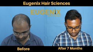 Hair Transplant Clinic in Bhubaneswar Odisha  Hair Transplant Surgeon  Eugenix [upl. by Anaid]