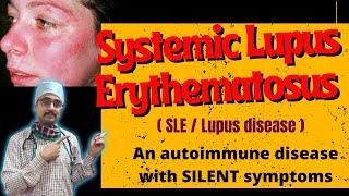 quotUnderstanding SLE Lupus Treatment Options Lupus Nephritis and Lupus Blood Disorders and NMOSDquot [upl. by Mulloy828]