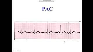 Premature Atrial Complex  Bigeminy  Trigeminy [upl. by Accissej]