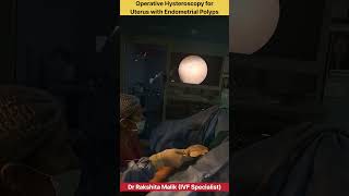 Operative Hysteroscopy for Uterus with Endometrial Polyps by Dr Rakshita Malik doctor mbbs ivf [upl. by Hakeem]