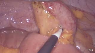 Laparoscopic appendectomy unedited 882024 [upl. by Fonz]