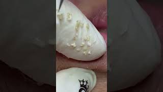 lip blackheads highlight  blackhead extraction removal pimple lips [upl. by Aicilas]