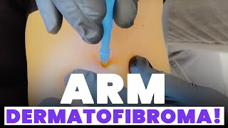 ARM DERMATOFIBROMA [upl. by Treblihp]