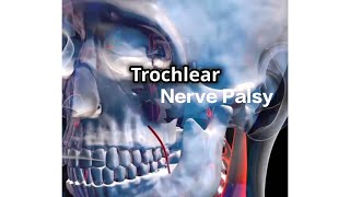 Trochlear Nerve Palsy  English [upl. by Adnalahs]