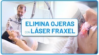 👀 Cómo quitar las OJERAS en solo 5 minutos con LÁSER TRATAMIENTO DEFINITIVO [upl. by Aleahpar]