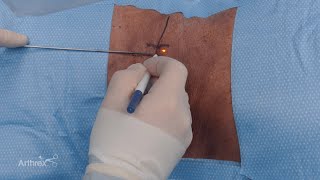 Endoscopic Approach to Transforaminal Discectomy [upl. by Seabrook]