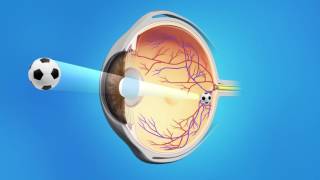 Cataract Surgery with a Multifocal Lens [upl. by Drusus]